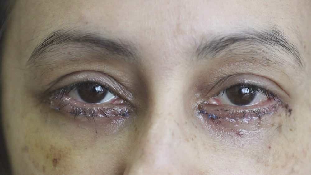 Swollen Eyelid After Pulling Eyelash